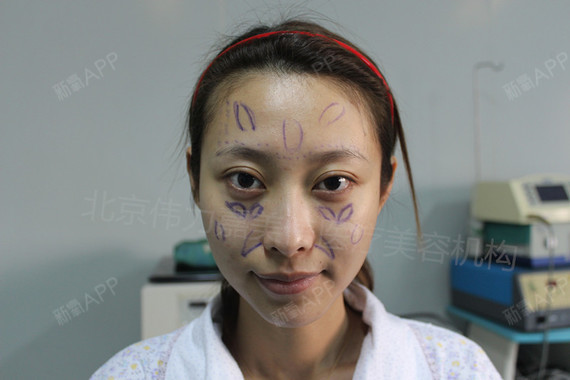 王自谦自体脂肪全脸填充第1天美丽日记-新氧美