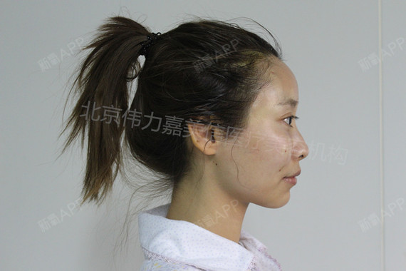 王自谦自体脂肪填充全脸第2天美丽日记-新氧美