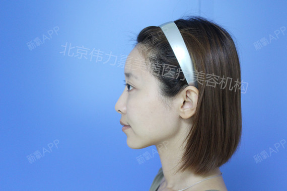 王自谦自体脂肪填充全脸第127天美丽日记-新氧