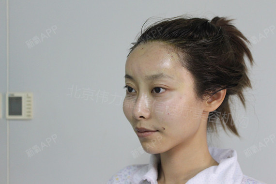 王自谦自体脂肪填充全脸第2天美丽日记-新氧美