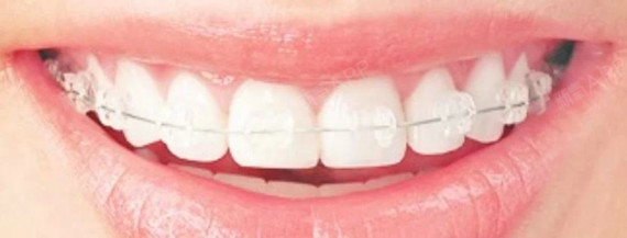 【韩国多仁牙科医院】在韩国牙齿矫正需要多久