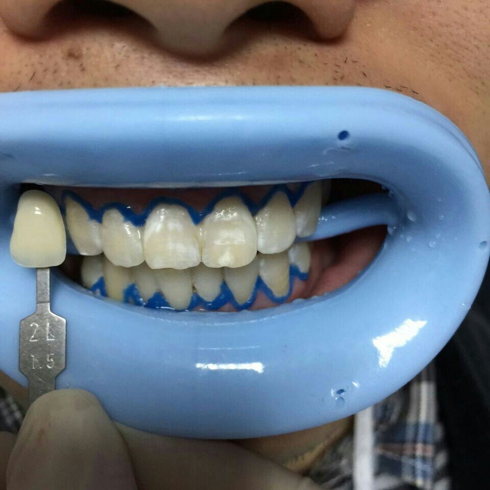 新氧- 小齿齿 | 术后当自强 | 冷光美白 | 牙齿 | 国内整形 | 青岛