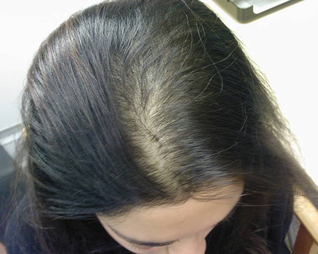 女性雄性激素性脱发也称为弥漫性脱发,表现形式是整个头发稀疏细软,发