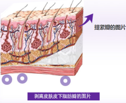 面部上提术[:6]脸部皮肤组织里的皮下脂肪层下面特
