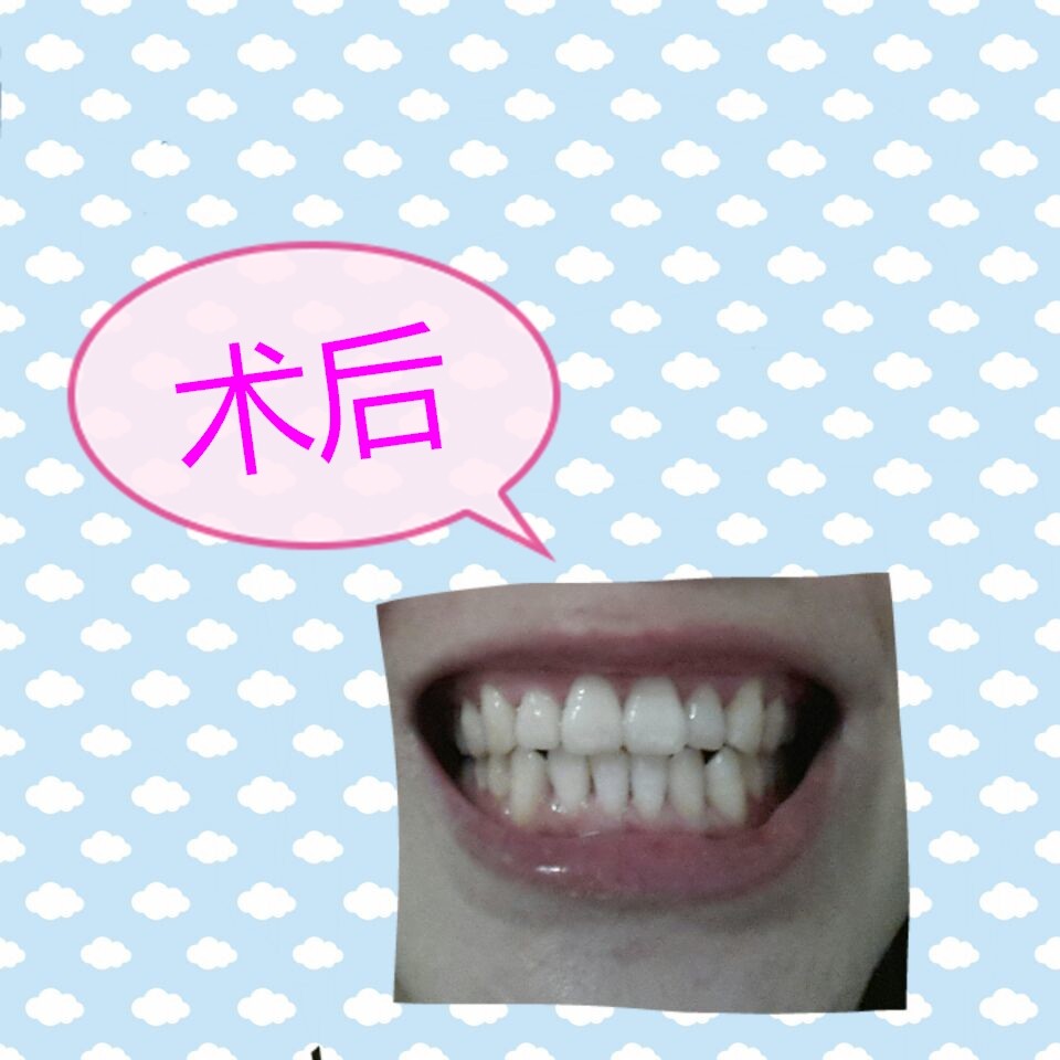 新氧- 丶那双眼动人 | 术后当自强 | 冷光美白 | 牙齿 | 优惠,活动