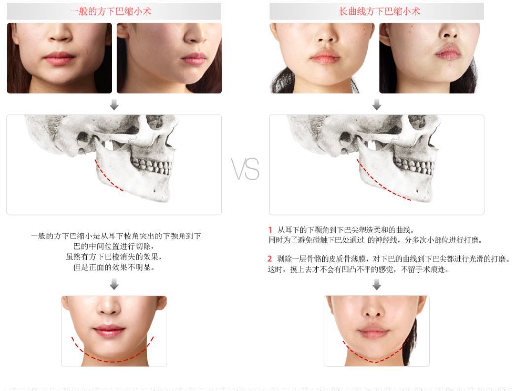 从耳下的下颌骨到 下巴尖塑造柔和的曲线 _ 韩国 tl 整形的阶段升级