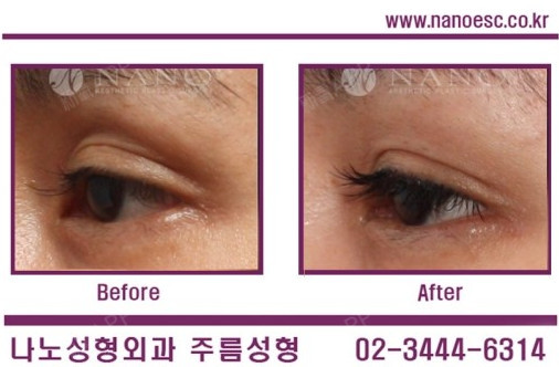 【NANO整形外科】通过上眼睑脂肪填充(眼皮