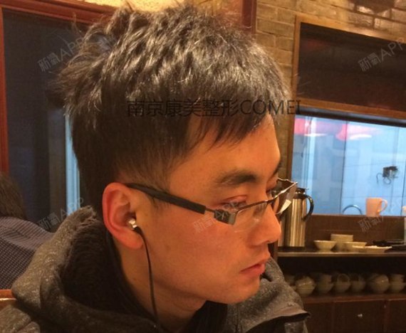 南京康美整形医院切开双眼皮第2天美丽日记-新