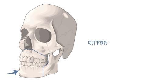 韩国【da整形外科】凸嘴手术 vs 两颚手术,该做哪一个?