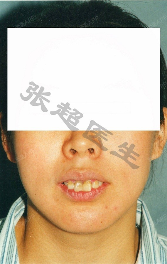 俗称"龅牙"畸形,患者上颌突出,牙齿唇倾,闭口不能,手术为"上颌骨根尖