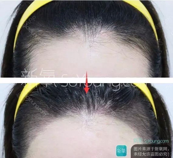 【偶像们都发际线癌了,你还远吗?】