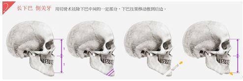 倒关牙长下巴整形!