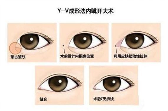 开内眼角与外眼角的区别及手术详解整形专家张诚很多人都知道通过开眼角手术可_圈子-新氧美容整形