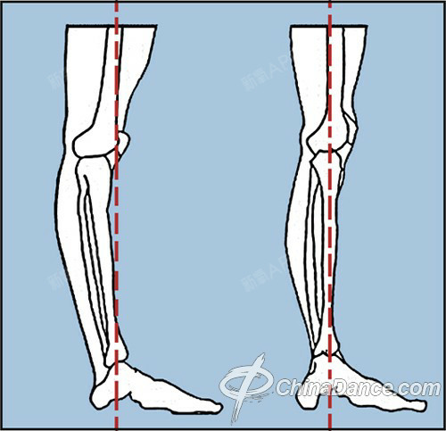 我的腿是左边,小腿向后弯曲,大腿比较向前_圈子-新氧