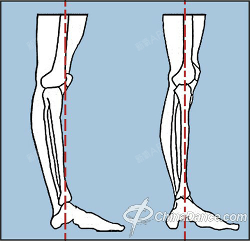 我的腿是左边,小腿向后弯曲,大腿比较向前,膝盖向前,.