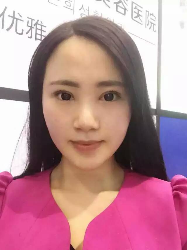 韩国恩喜整形内部员工韩式三点双眼皮和开内眼角项目真人案例