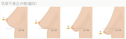 产后乳房萎缩七招巧防治 上一组断奶后乳房萎缩七招防治 乳房萎缩下垂