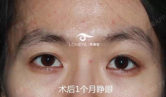 复发性重度上睑下垂术后一个月能恢复成啥样_