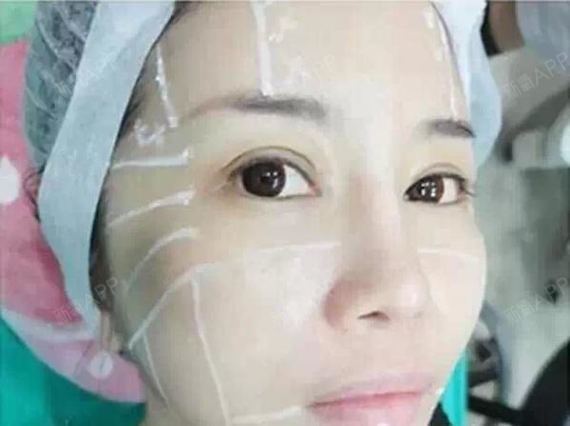 太原丽都整形美容医院激光祛痘印第52天美丽