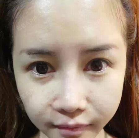 太原丽都整形美容医院激光祛痘印第52天美丽