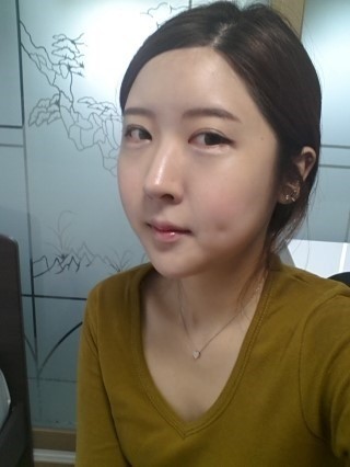 这是3D回转颧骨+棱角下巴矫正整形后记。手术前整个_圈子-新氧美容整形