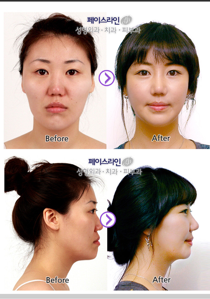 这回是鼻头丰满的大鼻子(福鼻)~因为鼻头大又丰满而苦恼的童鞋们~可以