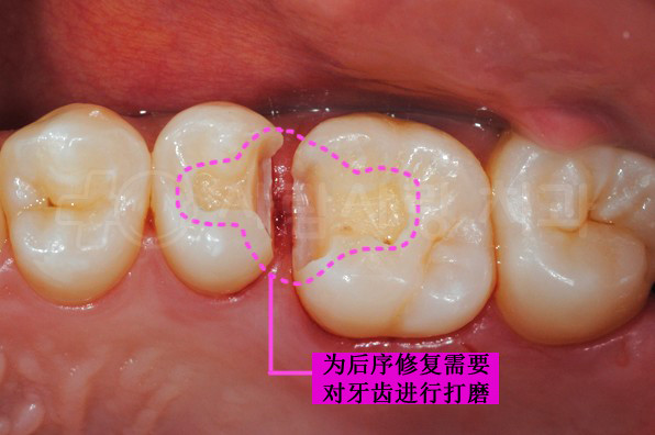 為了後序治療填充修復材料的需要,把牙齒的邊緣稍微進行打磨