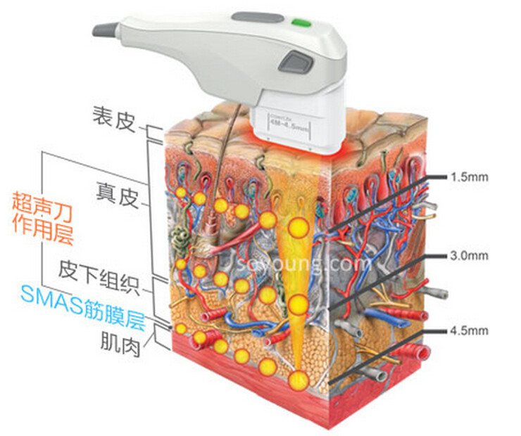16韩国一周最热门整形手术排名第一位:ulthera】现在韩国是微整