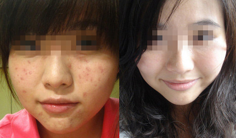 【果酸焕肤】进口果酸告别油腻腻 祛痘 嫩肤 美白