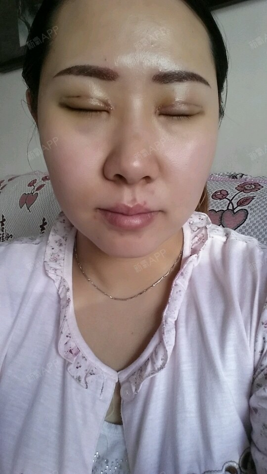 第三天了,刚冰敷完,还是肿肿的,这两根大肉条