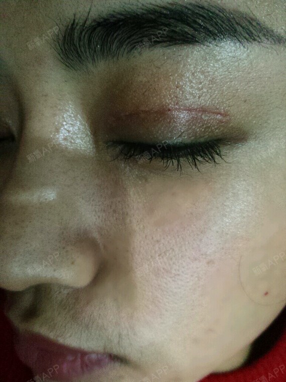 拆线第三天,做的全切法双眼皮,疤很明显,后期怎么办_圈子-新氧美容