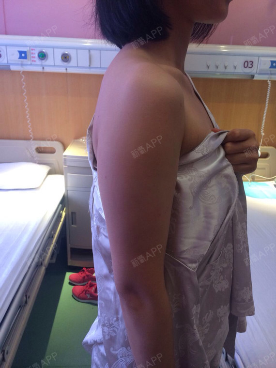 今天做了上臂吸脂.各种紧张.