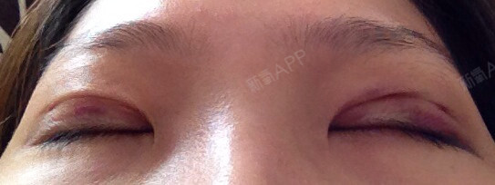 第二天了,左眼比较肿,还发紫了.像条紫色眼线哈哈._圈子-新氧美容整形