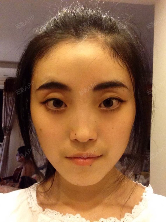 我这个眼睛是去做那种手术好呀?我眼皮挺薄的能用切开法吗?好捉急.