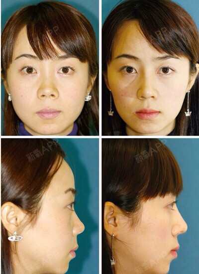 该案例由中国医生出品,术者先前鼻尖肥大伴有短鼻畸形,侧面鼻唇角