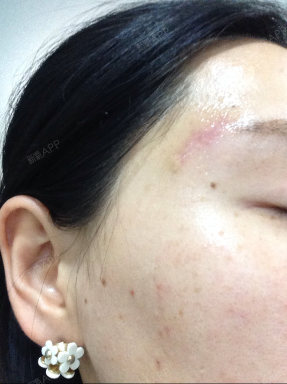 用了疤克五天了,不知道效果会怎么样,需要用药