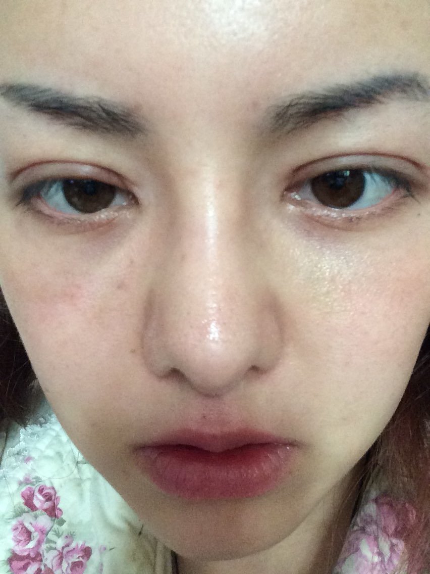 眼睛下面在国内做过去眼袋,现在眼睛下面凹陷特别厉害_圈子-新氧美容