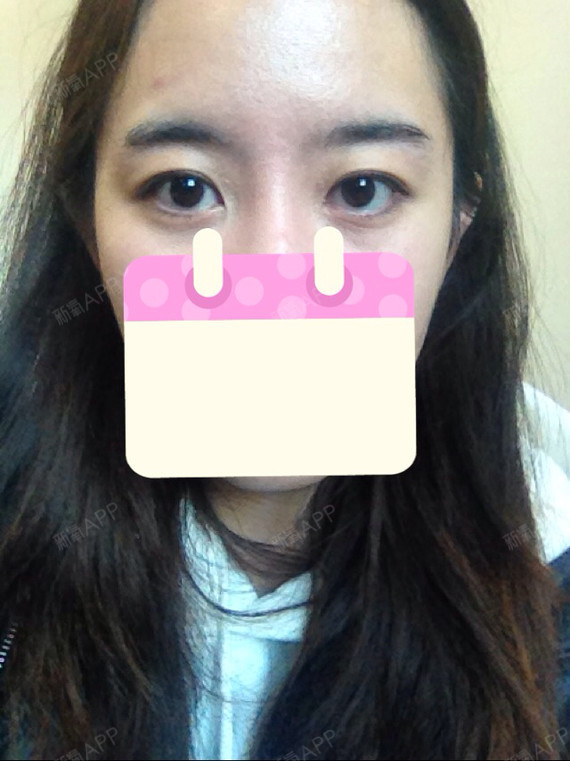 一直是圆眼,想开眼角,想改变眼型,又怕割完眼睛太大,而且我