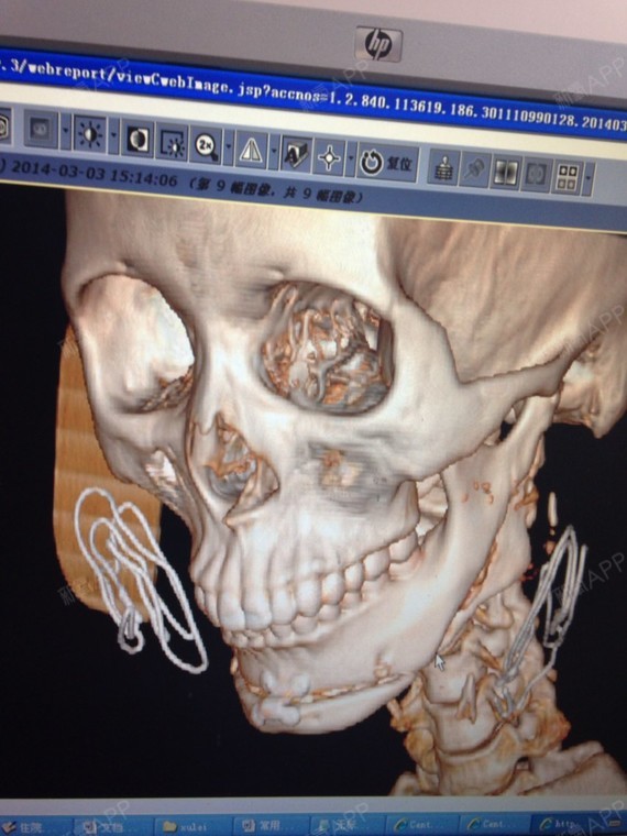 我削骨加下巴截骨前移.10个月了 下巴觉得很紧,好像有很多胶水?