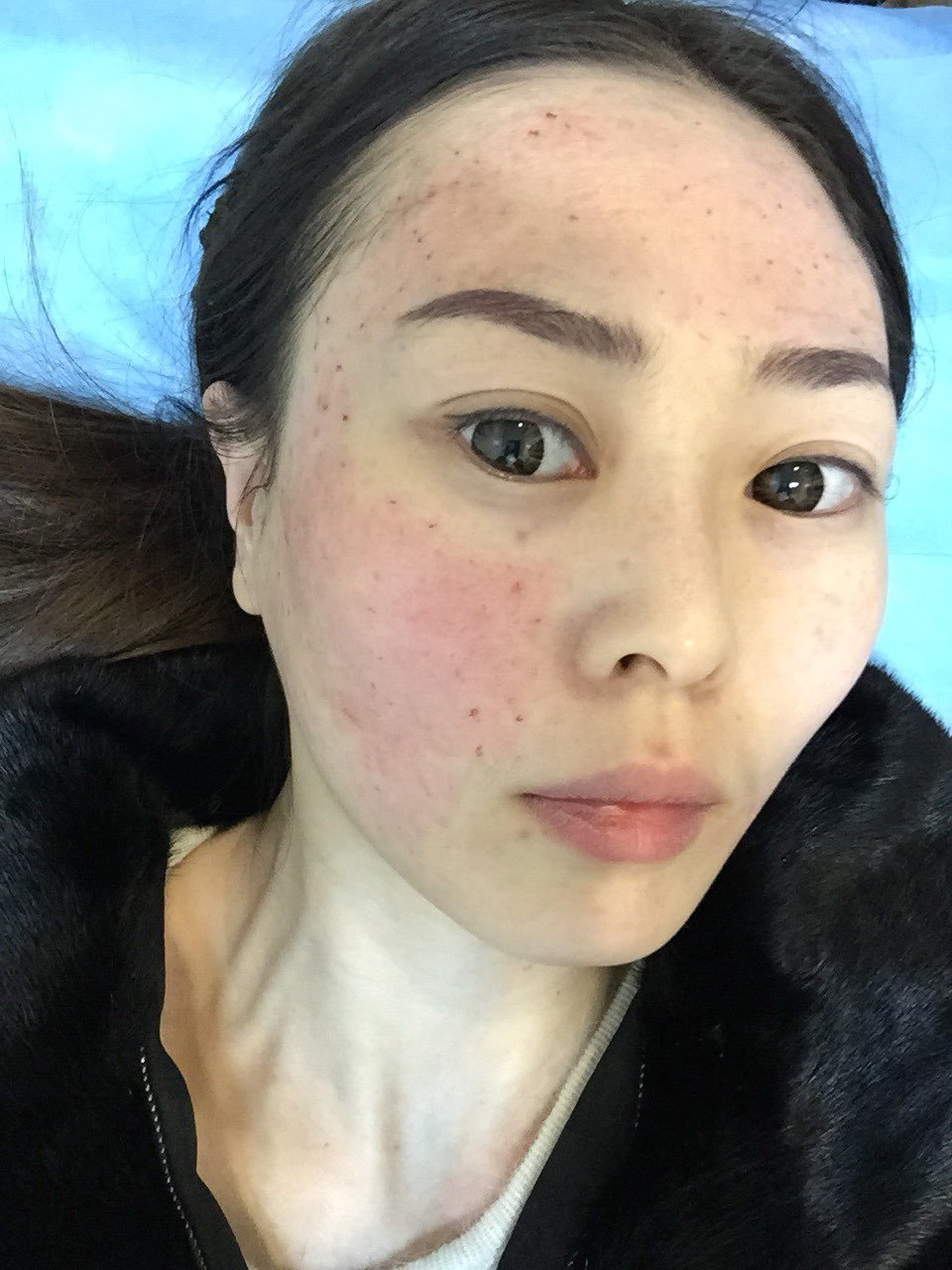 提前三天预约好从山西专程到宜健三医院做水光针想想皮肤会变好就开心