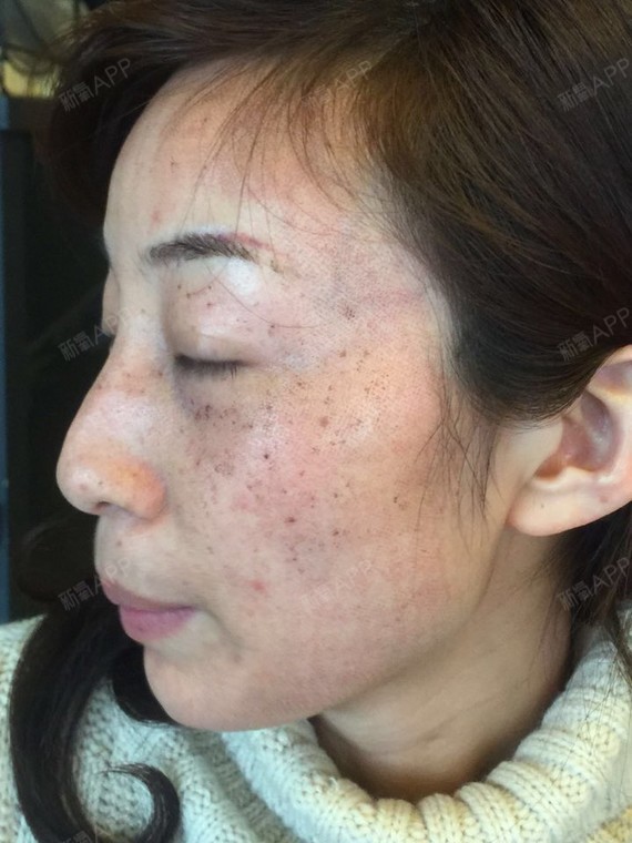 第6天 症状: 满意度: 肿胀度: 疼痛感: 疤痕度: b3501v1 文字说明