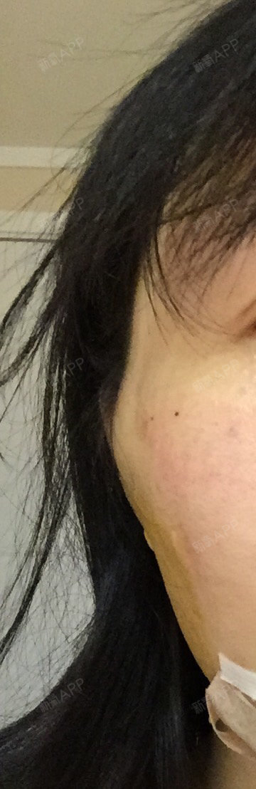 刚做完埋线提升,有一侧颧骨位置出现一个大鼓包是这么回事啊?