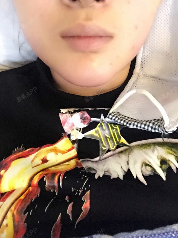 670723硅胶垫下巴第0天美丽日记