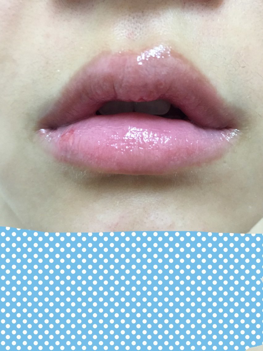 颜色很自然的,伤口基本上都恢复了,下唇还可以,但上唇情况不是很好,离