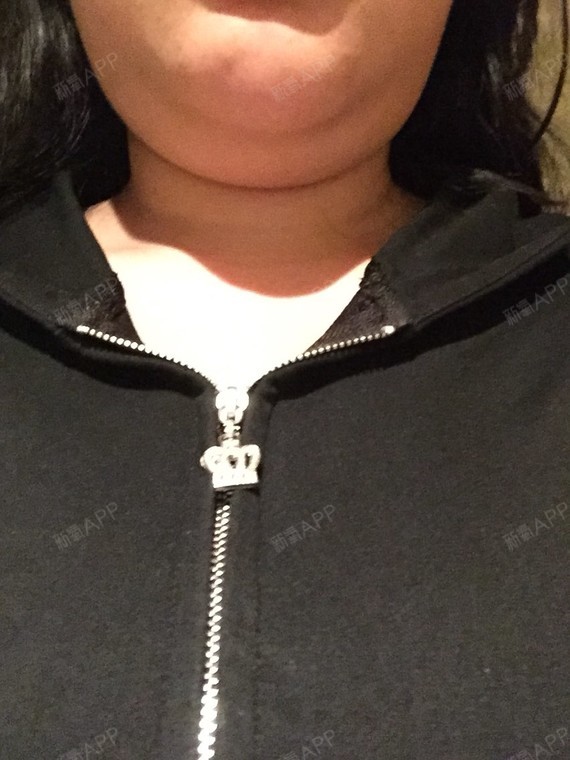 这双下巴不知道是我肿的原因还是怎么了,在等两天吧,在看效果