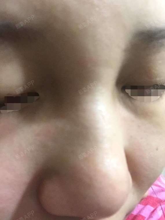 鼻根和下巴奥美定取出.