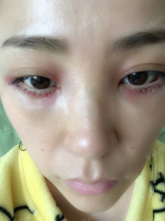 术后第一天…大家帮我看看…做的怎么样啊?