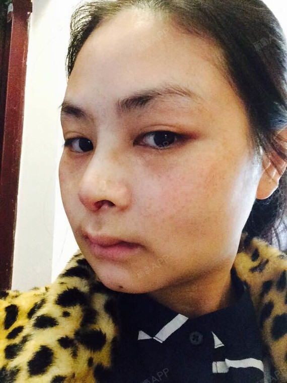 鼻侧有一点儿淤青,不过不_圈子-新氧美容整形