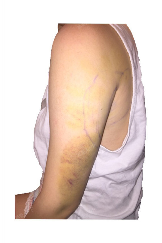 手臂抽脂手术第6天