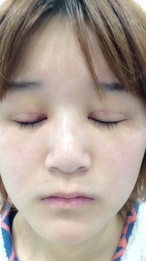 今天去拆线了 眼角伤口很明显 真的能好嘛 .